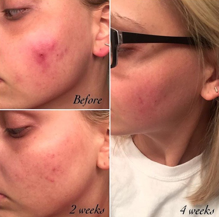 3-Step Acne Skincare System