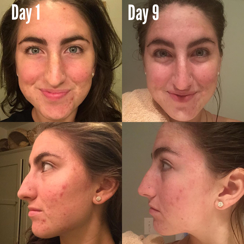3-Step Acne Skincare System