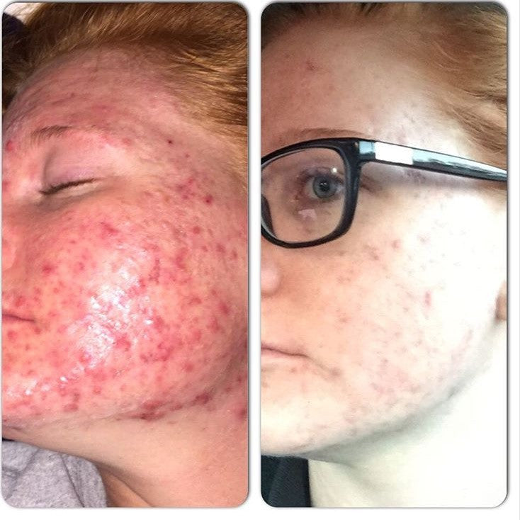 3-Step Acne Skincare System