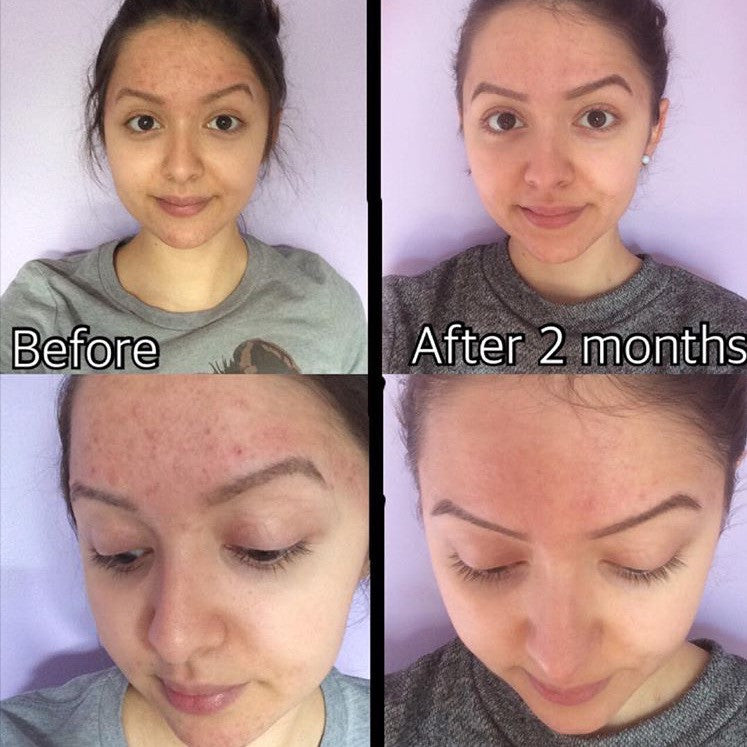 3-Step Acne Skincare System