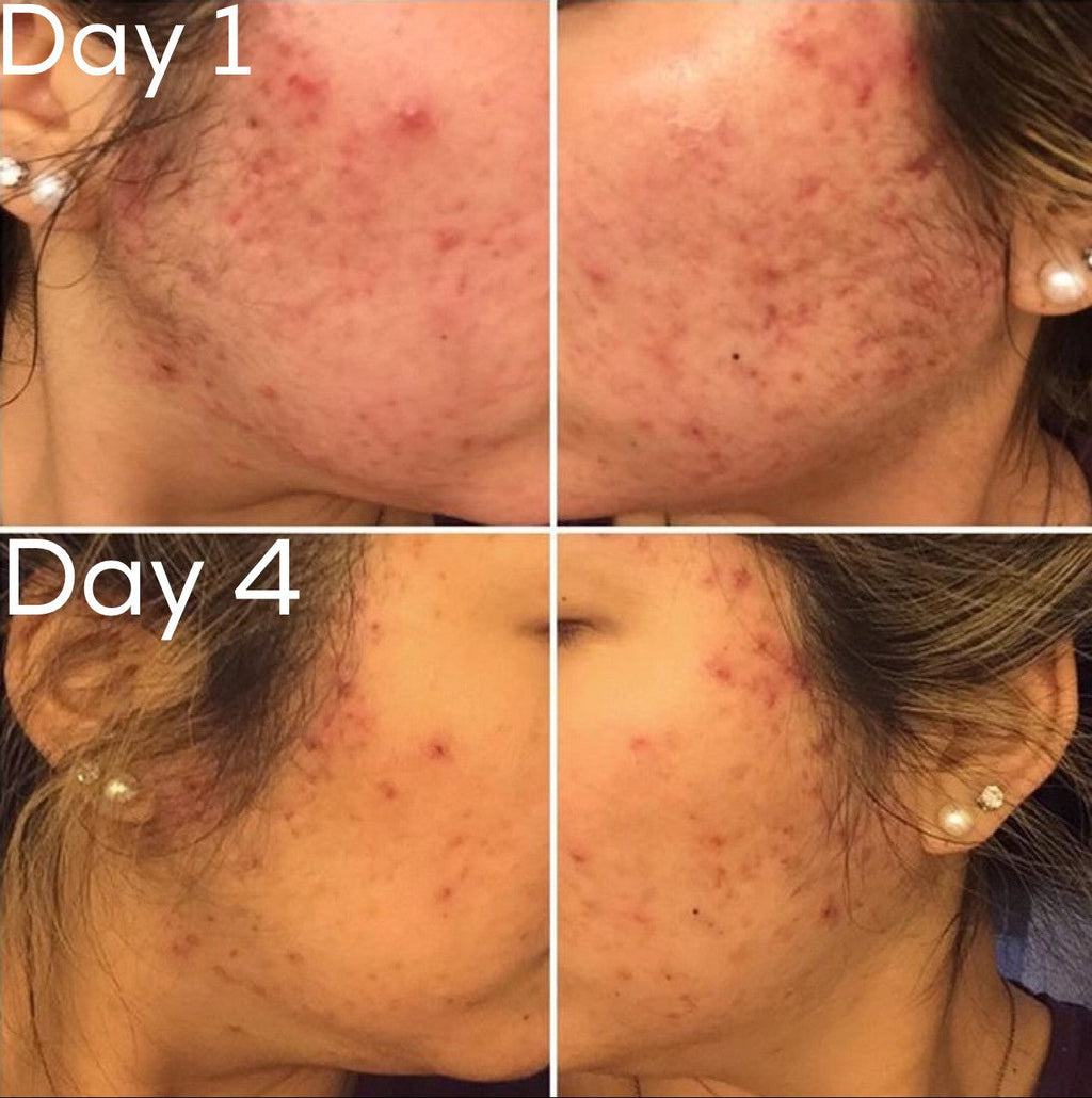 3-Step Acne Skincare System