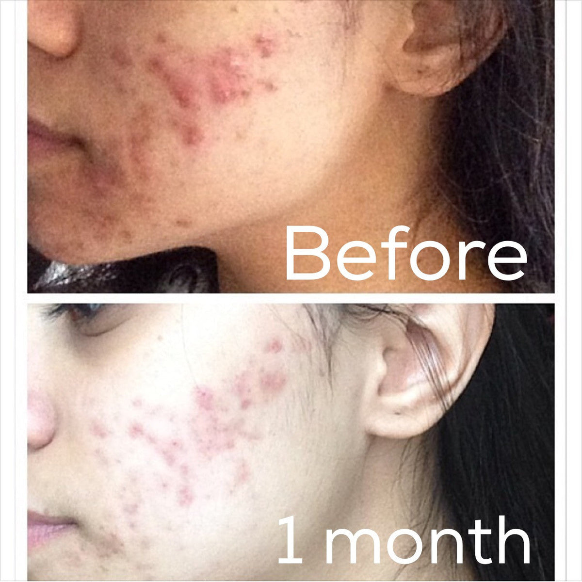3-Step Acne Skincare System